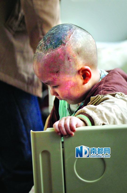 2歲男童遭父親毆打燙掉頭皮2歲男童遭父親毆打燙掉頭皮1