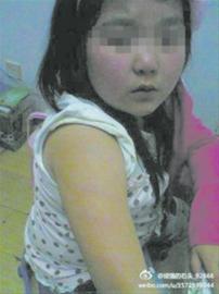 小學生沒考100分被老師打 兩個月不敢上學1