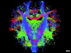 2013英國:英科學家繪制胎兒腦神經"動態路徑圖"[1]2