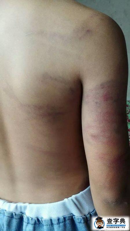 網貼稱教師體罰學生致遍體鱗傷 官方稱嚴肅處理2