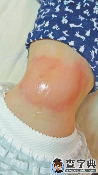 鄭州小學學生出現頭暈紅疹等癥狀 跑道疑似元兇1