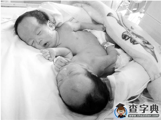 貧窮的父母拿不出30萬元手術費 這對連體寶寶會有未來嗎1