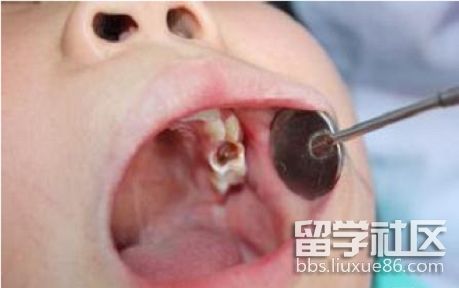 東北大學：兒童蟲牙與父母學歷有關1